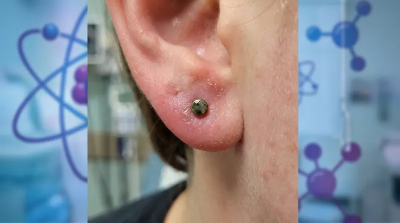 צילום מקרוב של תנוך אוזן אדום, נפוח ומודלק סביב עגיל צמוד, המעיד על זיהום או גירוי בפירסינג.